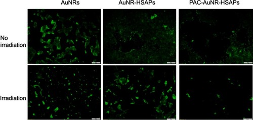 Figure 10 Fluorescence microscopy images of the cytotoxic effects on 4T1 breast cancer cells when treated with free AuNRs, AuNR-HSAPs or PAC-AuNR-HSAPs. (White scale bar denotes 100 μm). Reprinted with permission from Peralta DV, Heidari Z, Dash S, Tarr MA. Hybrid paclitaxel and 1030 gold nanorod-loaded human serum albumin nanoparticles for simultaneous chemotherapeutic and photothermal therapy on 4T1 breast cancer cells. ACS Appl Mater Interfaces. 2015;7:7101–7111.Citation10 Copyright 2015 American Chemical Society.