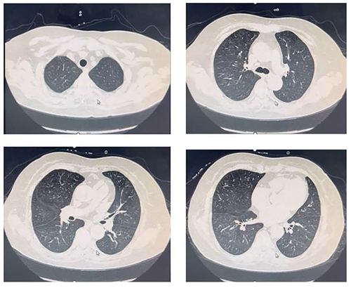 Figure 2 Chest CT showed bronchiolitis, excluding early alveolar hemorrhage.