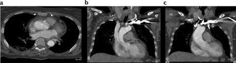 Figure 2 CT-Angio without gating. Pulsation artifacts misappared of aortic valve (a-c) and aortic arch thrombus (MPR: b); suspected ascending aorta intimal flap (MPR: c)