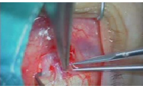 Figure 2 About 10% of the muscle’s surface fibers and related fascia were dissected from the remaining 90% deeper fibers with scissors.