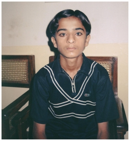 Figure 2 A 13-year-old boy underwent right monocular strabismus surgery (15th postoperative day).