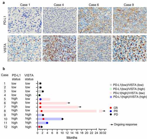 Figure 4. The PD-L1 and VISTA expression were associated with the response to blockade of PD-1. (a). The representative images of the PD-L1 and VISTA expression in indicated groups. (b). Swimmer’s plot showing the response to PD-1 blockade in extranodal NK/T-cell lymphoma patients, who were classified into four groups as indicated. CR, complete response; PR, partial response; PD, progressive disease