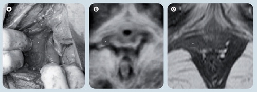 Figure 4. Right-sided puborectalis avulsion after normal vaginal delivery at term.(A) Shows appearances immediately postpartum, with the avulsed muscle exposed by a large vaginal tear. (B) Shows a rendered volume (axial plane, translabial 3D ultrasound) 3 months postpartum. (C) Shows MRI findings (single slice in the axial plane) at 3.5 months postpartum.Reproduced with permission from Citation[14].
