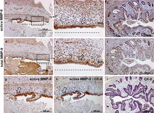 Figure 4. Representative images of immunohistochemistry staining results for active (A-C, G), total MMP-9 (d-f), double staining active MMP-9/CK-8 (h) and single staining for CK-8 (i) in human xenograft fistulas (n = 6). The histology of the human xenograft fistula is similar to the human fistula. Total and active MMP-9 positive cells are found around the fistula tract (a, b, d, e) and abnormal crypts (c, f). Epithelial cells in abnormal crypts are CK-8 positive (I) and myofibroblast-like single cells and TC are double positive when co-stained with MMP-9/CK-8 (h). Figures A, D, H show consecutive sections with higher magnifications found in B, E, G. Figures C, F and E show also consecutive sections from a different specimen. Dashed line indicates the fistula tract. Small arrows indicate enlargements. Large arrows indicate TC.