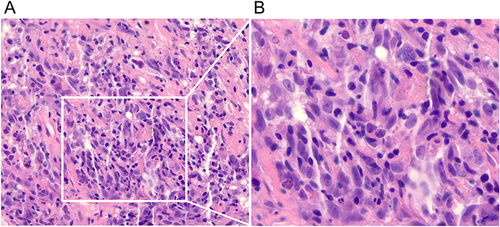 Figure 2 The results of hematoxylin-eosin staining on primary tumors. The liver mass aspiration biopsy revealed partial hepatocytes stasis, red-stained amorphous necrotic foci, and spindle cell hyperplasia fibrous tissue with lymphoid and plasma cell infiltration. The original magnification of the image is 100×. 100×(A) and 200×(B).