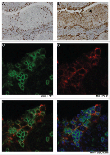 Figure 2. Close spatial association of PD-1+ and PD-L1+ cells suggests induction of ‘adaptive resistance’. Immunohistochemical (IHC) staining was performed to detect either PD-1 (A), (C, green) or PD-L1 (B), (D, red) on adjacent 5 micron sections of formalin-fixed paraffin-embedded tumor samples from a patient with HPV+ squamous cell carcinoma of tonsil. E and F are composite images of C &D. The close physical proximity of PD-1+ small mononuclear cells and larger PD-L1+ cells is ‘adaptive resistance’ – the inductive up-regulation of PD-L1 in response to the influx of tumor-reactive CD8+ T cells. Although initially described in the context of metastatic melanoma, ‘adaptive resistance’ may be a common pattern of immune subversion in many types of tumors, indicating the “activation” of the PD-L/PD-1 axis and likelihood of response to agents that block this pathway. IHC was performed with anti-PD-L1 (mouse anti-human mAb5H1 clone) followed by a secondary anti-mouse IgG (DAKO, USA) or anti-PD-1 (goat anti-human polyclonal antibody, R&D Systems) followed by a secondary biotinylated anti-goat IgG (Jackson ImmunoResearch, USA). For amplification, horse radish-peroxidase (HRP) was used and the reaction visualized with the DAB chromogen enzyme. Dual immunofluorescent IHC was performed by sequential staining with anti-PD-L1 (detected by red-fluorescent Alexa Fluor 647 tyramide, followed by anti-PD-1 detected by green-fluorescent Alexa Fluor 488 tyramide).