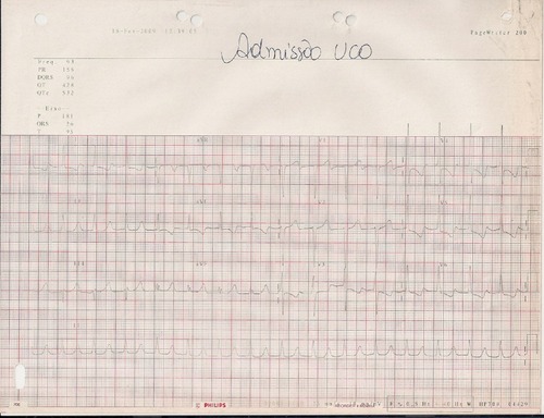 Figure 1 Admitting electrocardiogram.