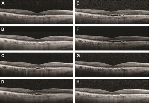 Figure 1 Worsening neovascular age-related macular degeneration after switching from ranibizumab to aflibercept.