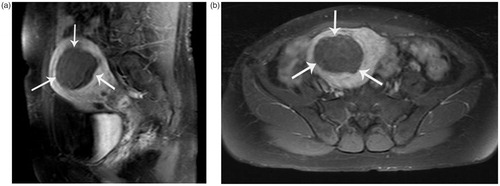 Figure 2. MR images in a 47-year-old woman with uterine myoma after microwave ablation therapy. (a) On contrast-enhanced MR images obtained 1 day after ablation, no enhancement is seen in the treated myoma, suggesting the complete necrosis of myoma (sagittal T1WI MR). (b) On contrast-enhanced MR images obtained 1 day after ablation, no enhancement is seen in the treated myoma, suggesting the complete necrosis of myoma (axial T1WI MR).
