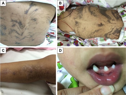 Figure 1 Patient’s skin and teeth manifestations.