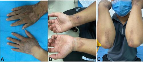 Figure 1 Patient with brownish-black plaque on the dorsal hands, surrounding the wrists and elbows, palms were not affected (A–C).