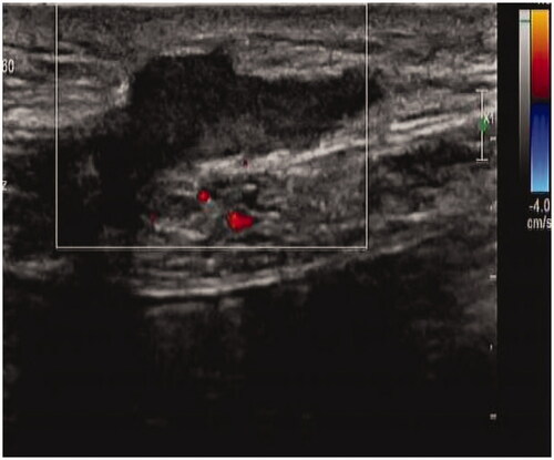 Figure 1. B-Mode Ultrasound Image of case 1.