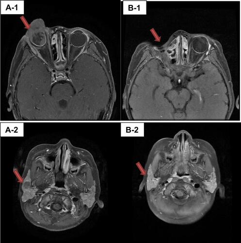 Figure 1 RB case with metastasis to parotid gland. (A-1) T1WI+C FS Status after vitrectomy (misdiagnosed at onset) in the right eye. Irregular equal T1 signals can be seen around the eyeball, locally protruding outside the orbit, and the enhanced scan is slightly enhanced, involving the lacrimal sac area and extraocular muscles. (A-2) T1WI+C FS Abnormal signal in the right parotid area with swollen lymph nodes, and the enhanced scan showed uneven enhancement. (B-1) T1WI+C FS Postoperative state of the right eye, with mild and uneven enhancement of the orbital fat body; (B-2) T1WI+C FS The original parotid gland area and lymph node enlargement subsided.