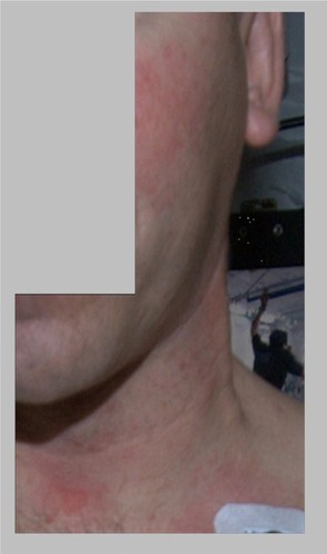 Figure 4 Photograph of a persistent rash incident on a US astronaut during long-duration spaceflight on board the International Space Station.