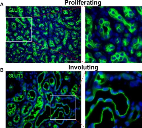 Figure 3 Both proliferating (A) and involuting (B) IH endothelial cells express GLUT1 (green).