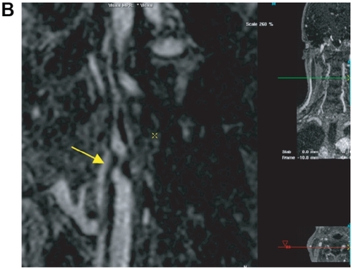 Figure 4 Patient with symptomatic abdominal aortic aneurysm referred for peripheral MRA. The high grade stenosis of the left internal carotid artery was confirmed by 64 multi-slice CTA and the patient was discharged after successful thrombendarterectomy and aneurysm repair. After first-pass MRA of the abdomen and lower extremities (A), an ultra-sonographically suspected stenosis of the left internal carotid artery is confirmed by the 0.66 mm isotropic resolution steady-state gadofosveset-enhanced MRA (B, arrow). This approach facilitates the pre-operative work-up of patients with systemic vascular disease without the need of a second contrast injection or a separate MR-examination. Image courtesy Winfried Willinek, Department of Radiology, University of Bonn/Germany.