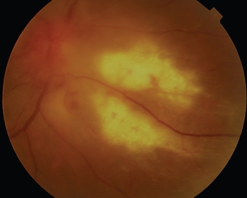 Figure 1 Right fundus photograph illustrating a large, dense, whitish retinal lesion extending inferonasally from the disc with some intraretinal hemorrhage surrounding the lesion.