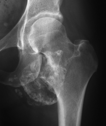 Figure 2. Anteroposterior radiograph 19 years after the image in Figure 1, suggestive of soft tissue mass containing multiple peripheral calcifications with ill-defined margins.