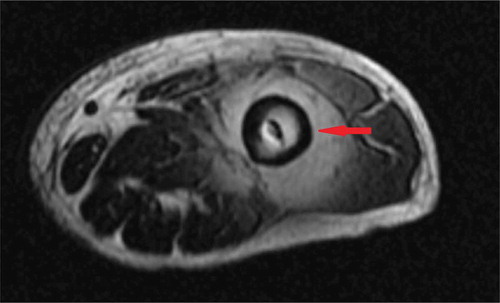 Figure 2. MRI without contrast of the hip showing the fluid collection around left hip joint (red arrow).