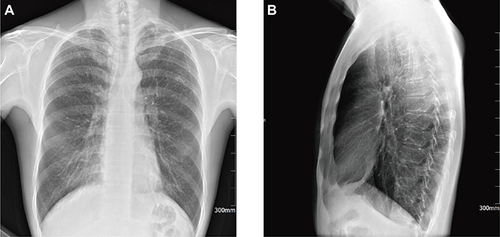 Figure 3 Chest X-ray of the patient on May 14, 2018. Extensive interstitial changes in both lungs: posteroanterior view (A) and lateral view (B).
