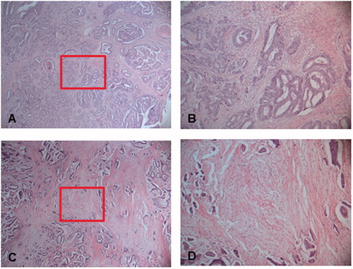 Figure 1. Representative images of a tumor with a low stroma content (high TSR) at (A) 25× and (B) at 100×, and a tumor with a high stroma content (low TSR) at (C) 25× and (D) at 100×. The boxes outline the sections illustrated in (B) and (D), respectively. Tumor cells were to be present at all borders of the selected image field (north-east-south-west).