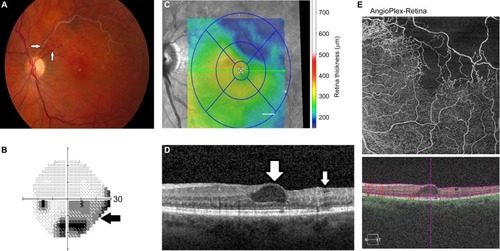 Figure 1 BRVO, left eye.