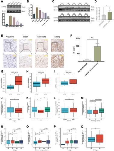 Figure 5 Expression levels of LHFPL6 in gastric cancer (GC), and the mRNA expression of LHFPL6 in different sample types and patients with different clinicopathological characteristics. (A and B) Differential expression of LHFPL6 in normal gastric epithelial cells and GC cells.(C and D) Western blots demonstrating LHFPL6 protein expression in cancerous tissues and adjacent non-cancerous tissues.(E) Representative images of tissues with different LHFPL6 immunohistochemical staining intensities.(F) Statistical comparison of LHFPL6 expression levels (H-SCORE) between paracancerous and GC tissue (n=10).(G–I) mRNA expression of LHFPL6 in gastric cancer (GC) vs normal gastric tissue, obtained based on three independent GSE datasets. (J–Q) Association of LHFPL6 expression with age, sex, race, histologic grade, T/N/M stage, and the primary treatment outcome of GC patients. *P < 0.05, **P < 0.01, ***P < 0.001.