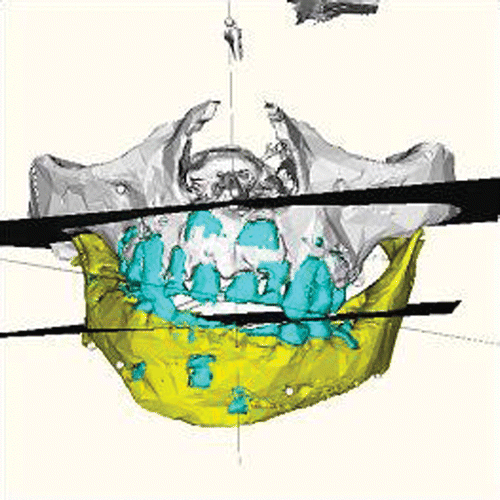 Figure 9. Modified occlusal plane chosen in reference to Camper's plane. [Color version available online.]