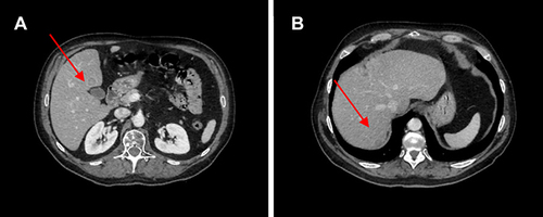 Figure 7 (A) and (B) Red arrows show liver metastases after 49 months of therapy with ribociclib.