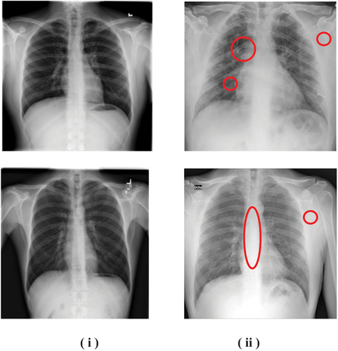 Figure 1. Chest X-ray Images of 4 patients (i) Normal (ii) Affected with coronavirus.(courtesy: https://www.kaggle.com/tawsifurrahman)