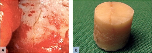Figure 6. A: Fracture line in the operating field surrounded by callus formation seen as a slight elevation of the surface. B: Bone biopsy including the fracture line.