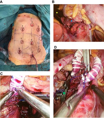 Figure 1 Different phases of a laparoscopic retrograde aorto-mesenteric bypass to the superior mesenteric artery. (A): Paramedian vertical lines are midclavicular and anterior axial lines. Upper transverse is subcostal, and lower transverse is the line joining the two anterior superior iliac spines. Trocar position 6 for 30° laparoscope, 1 and 9 for aortic clamps and 4, 5, 7 for working instruments. The rest of the trocar positions for other helping instruments. (B): Partially dissected superior mesenteric artery (Display full size) and infrarenal aorta (Display full size). Treitz ligament is divided, and duodenum mobilized distally and held under a retractor (Display full size). Inferior mesenteric vein (Display full size). (C): End-to-side anastomosis with superior mesenteric artery. (D): Completed anastomoses on superior mesenteric artery and infrarenal abdominal aorta. Ring enforced expanded polytetrafluoroethylene graft with an end-to-side anastomosed 6 mm graft. Side graft (Display full size) is being flushed with heparinized NaCl to check the patency of anastomoses before the aortic and superior mesenteric artery clamps are removed. Laparoscopic bulldog artery clamp (Display full size).