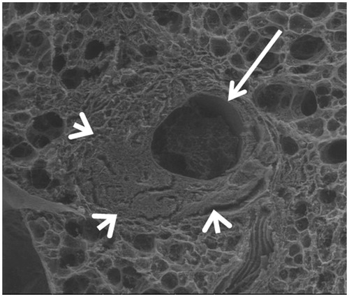Figure 5. Scanning electron microscopy. Axial slice, showing a widely open tract (arrow). Condensation of the lung parenchyma around the tract (arrowheads).