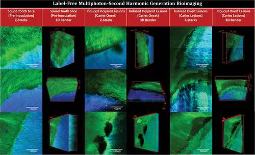 Figure 2. Multiphoton-second harmonic generation (MP-SHG) bio-imaging examination of the dentin-enamel junction area before and along the course of ex-vivo dental caries induction. The green signals show the MP autofluorescence emitted from the mineralized phase (mainly enamel). The blue signals show the SHG exclusively emitted from the collagen network of dentin. The columns show the maximum intensity projection of the acquired Z-stacks and the 3D renders of sound teeth slices (pre-inoculation), induced incipient caries lesions (caries onset), and induced overt caries lesions; the videos are provided in Supplemental Videos 1. The rows show three representative samples; all tested samples are displayed in Supplement Figures 1 and 3