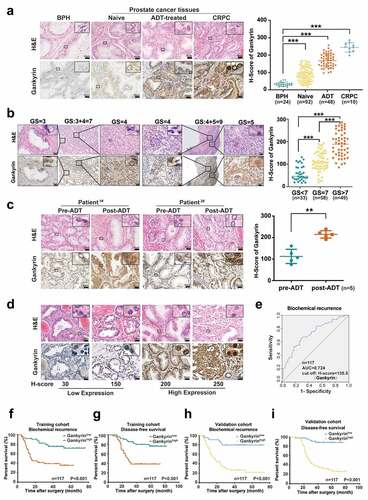 Figure 1. Gankyrin is commonly upregulated in prostate cancer and predicts unfavorable prognosis. (a), Representative immunohistochemistry (IHC) images for gankyrin in BPH tissues and localized prostate cancer, androgen deprivation therapy (ADT)-treated, or castration-resistant prostate cancer (CRPC) tissues. H-scores of gankyrin expression in different groups are shown. (b), Immunohistochemistry images of gankyrin in samples with corresponding Gleason Scores (GSs). H-scores of gankyrin expression in different samples are shown. (c), Pre-ADT and post-ADT tissues are from the same patient who received ADT. H-scores for gankyrin in the two groups are shown (right). (d), Representative images of gankyrin expression in prostate cancer tissues (Scale bar in A-D = 50 μm). (e), A time-dependent receiver operating characteristic analysis was to calculate the optimum cutoff value of gankyrin (H-score) to predict biochemical recurrence (BCR) in the training cohort. (f-g), Kaplan‒Meier curves of BCR (f) and DFS (g) were plotted based on gankyrin expression in the training cohort. (h-i), Kaplan‒Meier curves for BCR (h) and DFS (i) of prostate cancer patients were plotted based on gankyrin expression in the validation cohort(**p < .01 and ***p < .001).