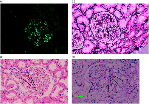 Figure 3. Pathological features of different glomerular diseases. (a) Immunofluorescence microscopy in a patient with IgA shows IgA deposition along the mesangial area (original magnification, 200×). (b) Glomerulus from a patient with idiopathic membranous nephropathy shows the thickened GBM stained with PASM (arrow) under a light microscope. (c) HE staining shows mild glomerular lesions and mild mesangial hyperplasia (arrow) from a patient with MCD. (d) The glomeruli with segmental sclerosis (arrow) are shown via PAS staining in a patient with FSGS. These images were provided by the Department of Nephrology of Shengjing Hospital. HE: hematoxylin-eosin; PAS: Schiff periodic acid; PASM: periodic acid-silver metheramine.