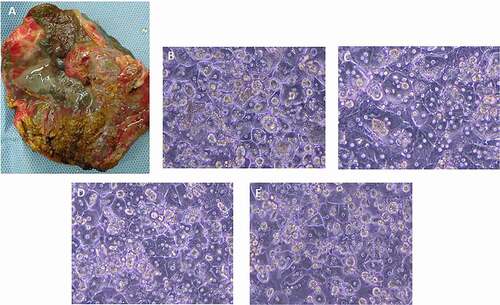 Figure 2. (a) Example of NASH liver explant, (partial segments 2,3, Child-Pugh score C) before cell isolation; ongoing liver damage causing significant disruption of the normal hepatic architecture; surface of affected liver becomes irregular and nodular, with a progression of fibrosis. Representative phase-contrast images of cultured hepatocytes from NASH (b), MSUD (c), and ALD (d) livers, 24 hr culture. (e) Phase-contrast image of hepatocytes isolated from an ALD liver, recovered from cryopreservation, 24 h culture.