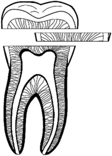 Figure 1. Extraction of dentin discs from a human third molar tooth.