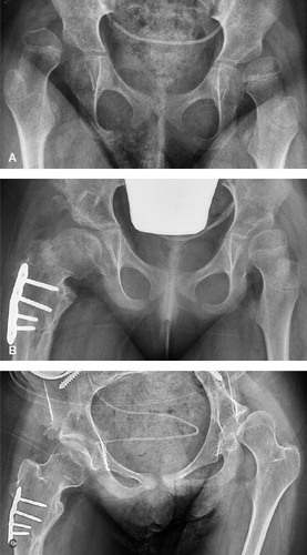Figure 3. A. Preoperative radiograph of a girl, aged 5.7 years and GMFCS level V, with complete dislocation of her right hip (MP 100%) and subluxation of her left hip (MP 51%). B. 14 months after femoral and pelvic osteotomies of the right hip and bilateral soft tissue releases, showing slight subluxation of both hips (MP right hip 36% and left hip 37%). C. 7.3 years postoperatively (age 13.0 years), showing good position of right hip and deterioration of left hip (MP 64%).