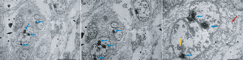Figure 6. Electron micrograph of the secondary tumors.Electron micrograph showed that tumor cells possessed large size and high nuclear/cytoplasmic ratio. The cells had the unequal thickness of nuclear membranes (yellow arrow), with many nuclei (blue arrow), uneven distribution of chromatin, and vacuoles in the cytoplasm (red arrow).