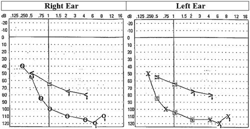 Figure 1. Results of free field measurement and inserted right and left ear audiogram.