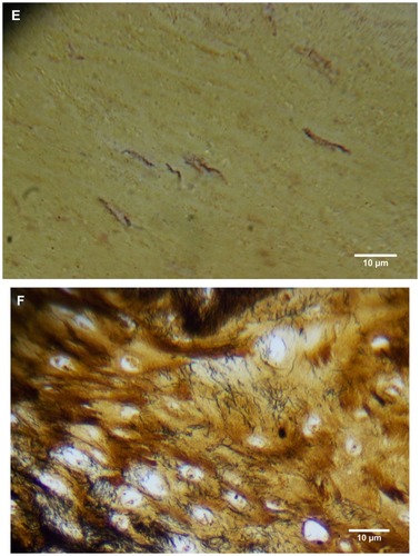 Figure 4 (A) Warthin–Starry-stained section of a Morgellons disease callus, patient 2, demonstrating a spirochete (arrow). 1000× magnification. (B) Dieterle stain, spirochete from patient 1 (arrow). 1000× magnification. (C) Dieterle stain, spirochetes from patient 2. 1000× magnification. (D) Dieterle stain, spirochetes from patient 3. 1000× magnification. (E) Dieterle stain, spirochetes from patient 4. 1000× magnification. (F) Warthin–Faulkner-stained bovine digital dermatitis section, showing numerous spirochetes among keratinocytes. 1000× magnification.