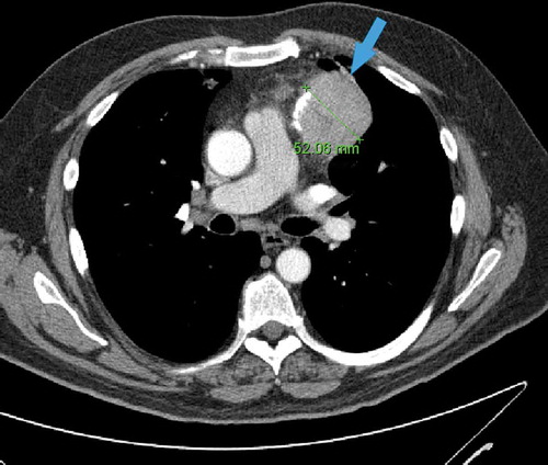 Figure 1. Axial contrast-enhanced chest CT scan showing a 52 mm round left anterior mediastinal mass with small foci of calcification (arrow)