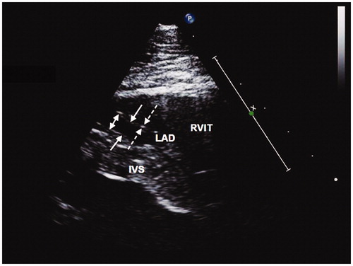 Figure 5. Modified parasternal long axis view showing LAD measurements. Dashed arrows demonstrate anterior wall thickness measurement, solid arrows demonstrate external elastic membrane measurement and double headed arrow demonstrates luminal measurement. RVIT: right ventricular inflow tract; LAD: left anterior descending coronary; IVS: interventricular septum.