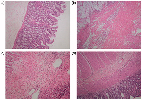 Figure 10. Histopathological analysis of colon tissue. (a) Normal mucosa. (b) Acetic acid induced colitis:pan hemorrhagic infarction, marked inflammation. (c) Treatment with marketed product showing neutrophil infiltration. (d) Treatment with F15: marked decrease in inflammation and neutrophil infiltration.