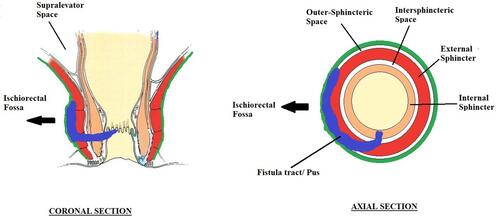 Figure 9 Schematic diagram highlighting that abscess/fistula tract in the outer-sphincteric space and its propensity to spread to the ischiorectal fossa.