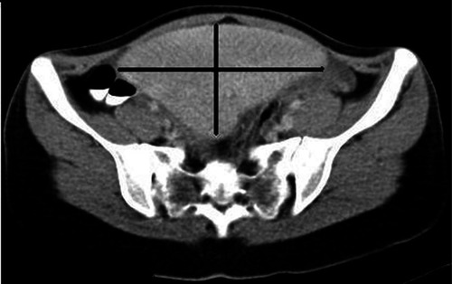 Figure 3 Pelvic location of the spleen in computed tomography.