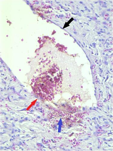 Figure 4 Skin biopsy: High power microscopic magnification showing thin-walled ectactic vessel (black arrow), point of extravasation (red arrow) and red blood cells in the dermis (purple arrow).