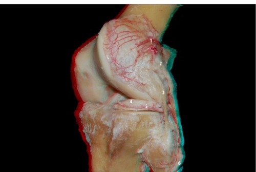 Figure 8 Oblique view of the posterolateral compartment of the knee: the pathway of the lateral inferior genicular artery (5) and the relationship with other structures: lateral superior genicular artery (1), popliteus tendon (2), lateral collateral ligament (3), lateral meniscus (4), and fibular nerve (6).