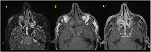 Figure 6. (A) Axial T2 FS weighted image shows markedly hypointense T2 signal of the intrasinus content primarily affecting the sphenoid and ethmoid sinuses owing to dense fungal concentration and heavy metals mimic air. (B, C) Axial T1 pre- and postcontrast images revealed peripheral enhancement of the inflamed mucosa within the affected sinuses.